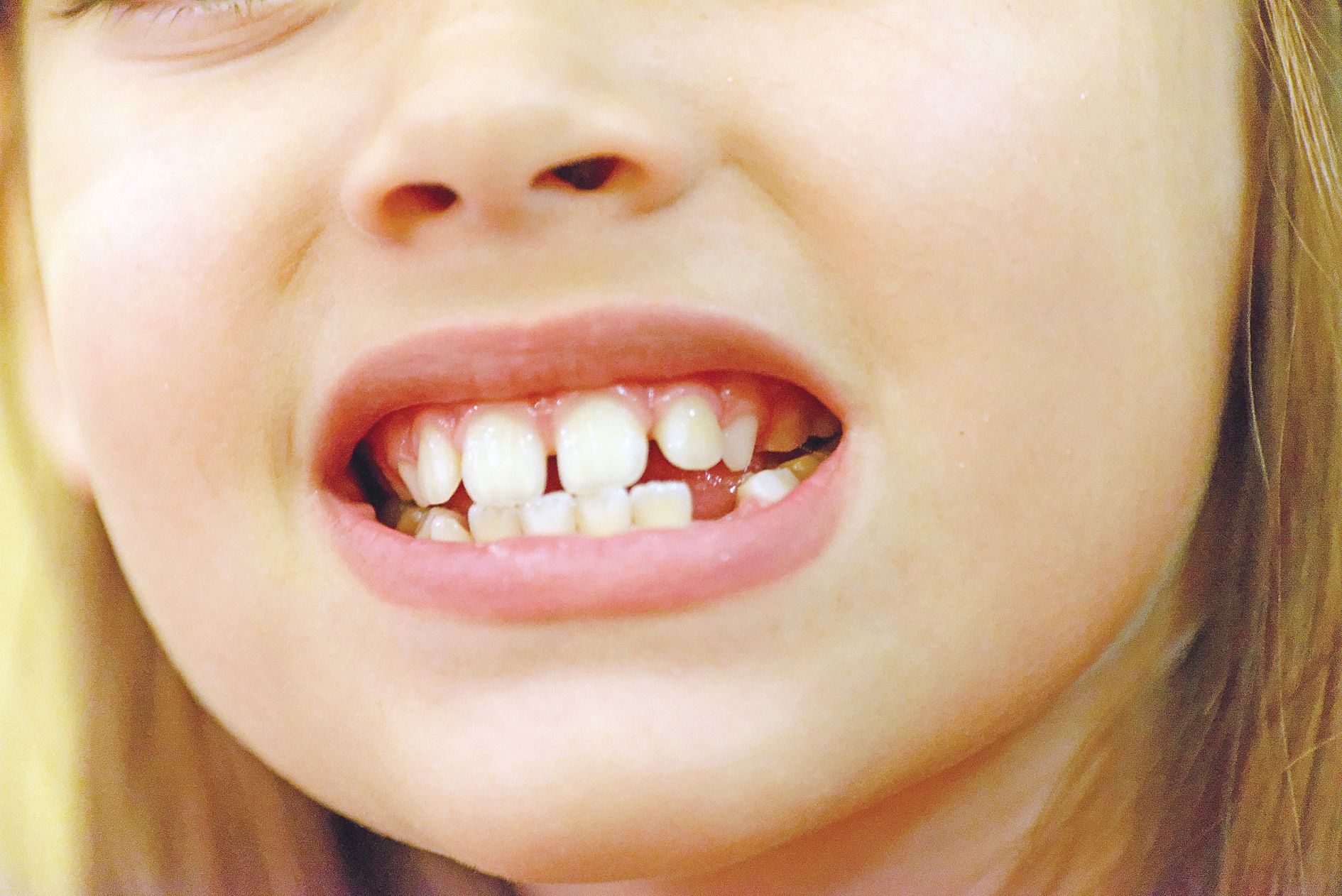 Une dent de lait cassée n’est jamais à négliger car  cet accident peut avoir un impact sur la dent définitive.