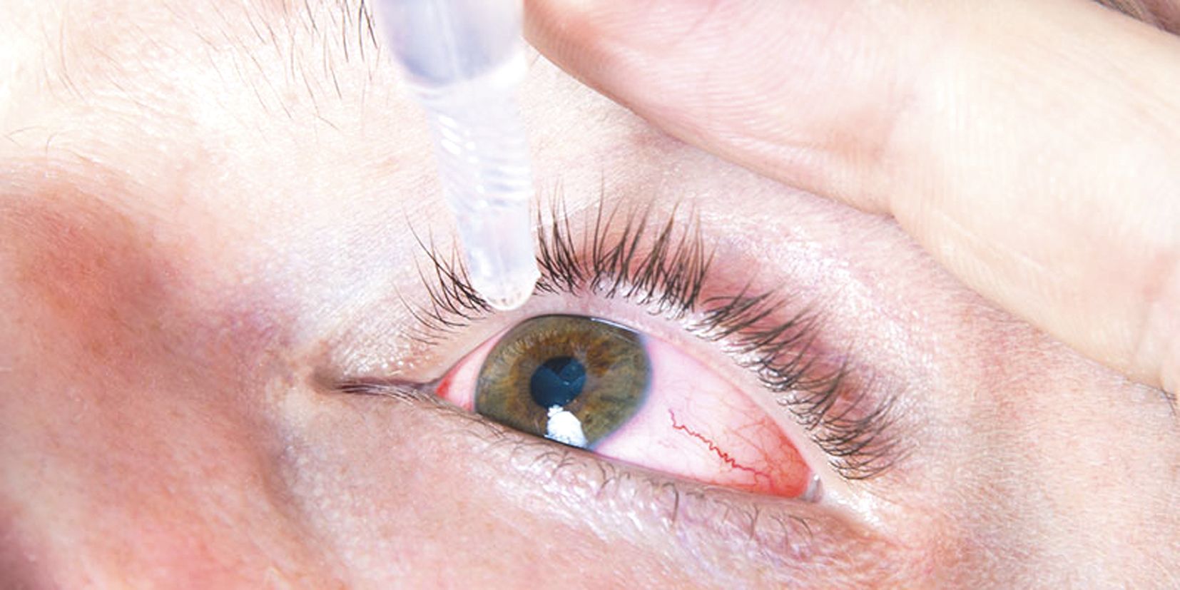 Pour le nettoyage des yeux, rincer l’œil avec du sérum physiologique ou un collyre prescrit par le médecin, et l’essuyer avec un mouchoir en papier à usage unique.