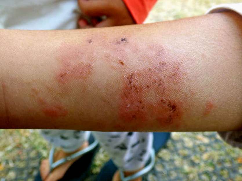 Bien que petites, les méduses qui dérivaient à Gatope n’en sont pas moins urticantes.Photo K.M.