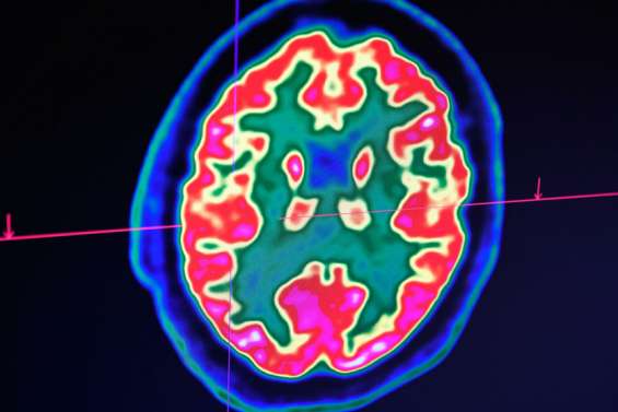 Sclérose en plaques : l'espoir d'une meilleure riposte à la maladie