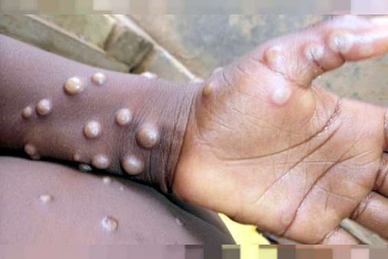 Un premier cas de variole du singe détecté sur le Caillou
