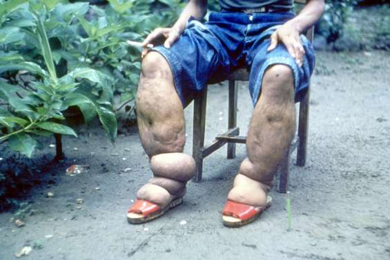 Santé : l'éléphantiasis, maladie qui déforme les membres, bientôt éradiquée du pays ?
