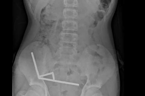 Nouvelle-Zélande : un adolescent opéré après avoir ingéré près de 100 aimants achetés sur Temu