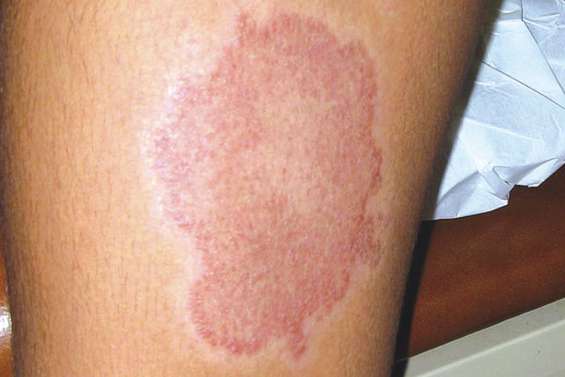 Appel à la vigilance face à  une recrudescence de la lèpre