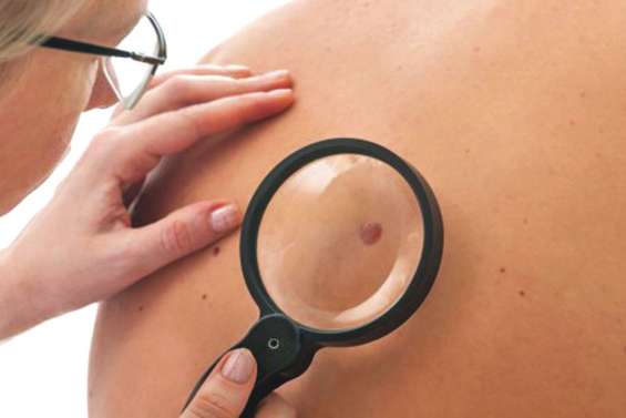 Un test sanguin pour détecter les mélanomes