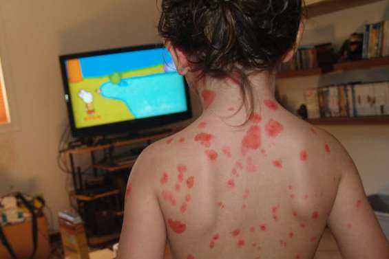 Comment faire face à la varicelle