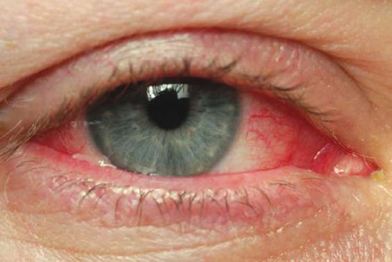 Epidémie de conjonctivite virale ultra-contagieuse