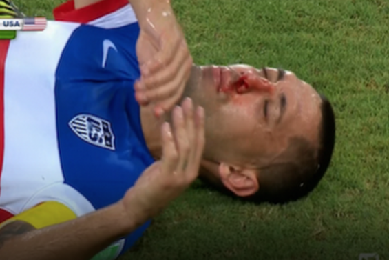 nez cassé pour Dempsey ? 