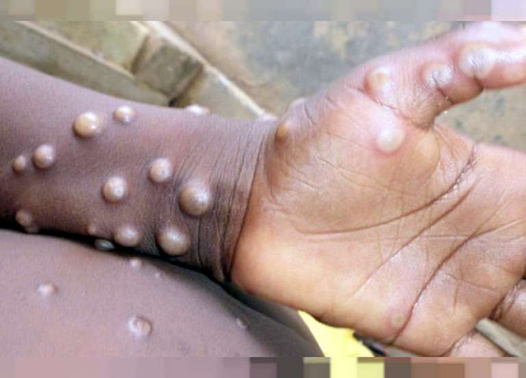 La variole du singe s'étend en Europe