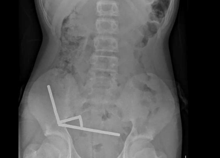 Nouvelle-Zélande : un adolescent opéré après avoir ingéré près de 100 aimants achetés sur Temu